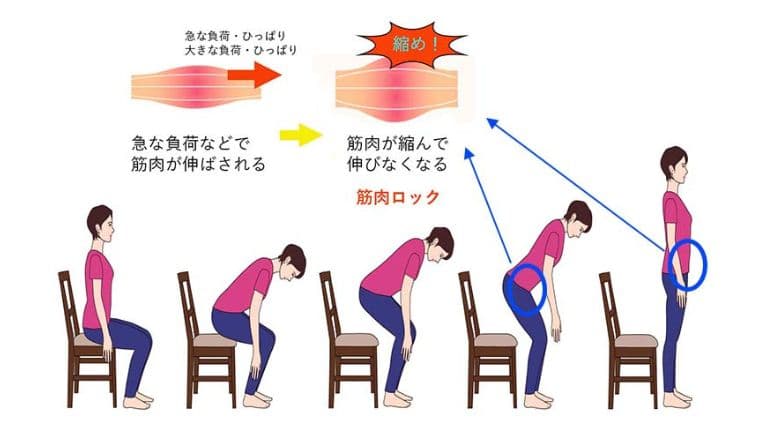 日常生活での筋肉ロック