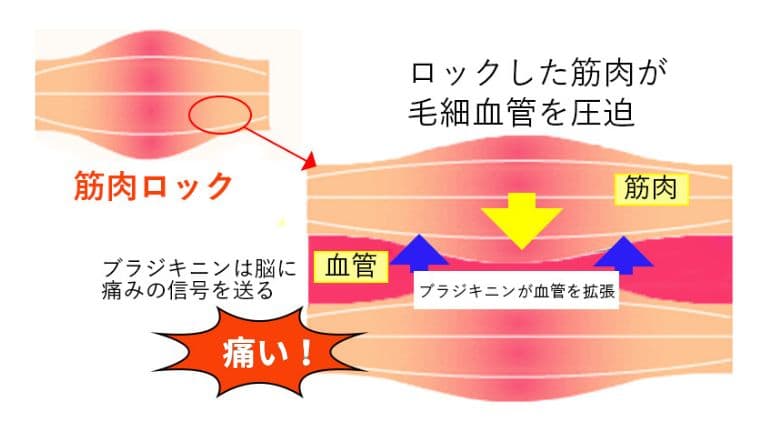 筋肉ロックによる血流不足と痛み